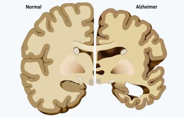 Cambios morfológicos del cerebro afectado por Alzheimer Cambios morfológicos del cerebro afectado por Alzheimer