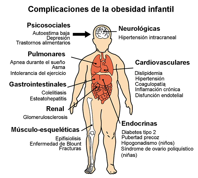 Son tantas y tan variadas las posibles complicaciones de la obesidad infantil como sus causas obesidad infantil
