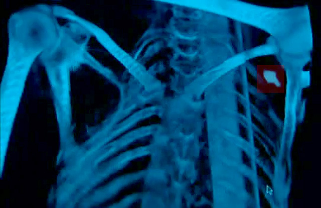 Punta de flecha en hombro de Otzi