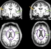 Neuroimágenes antes y después de covid