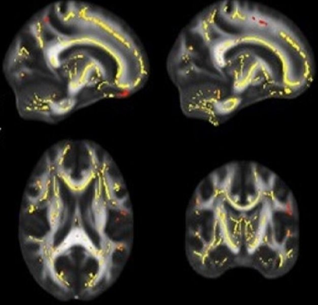 Imágenes del cerebro que muestran la funcionalidad de la materia blanca en los sujetos del estudio